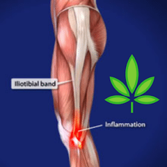 Treating ITBS with Cannabis